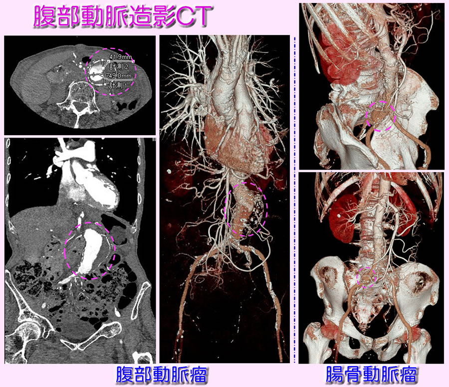 腹部動脈瘤