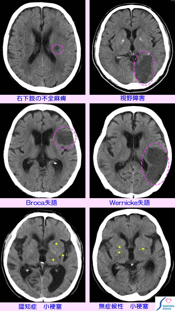 種々の脳梗塞