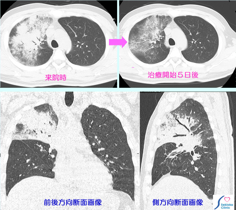 肺炎