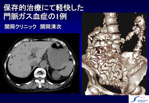 門脈ガス血症