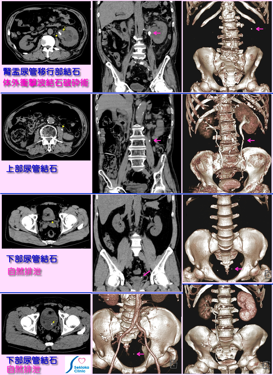 腎尿管結石