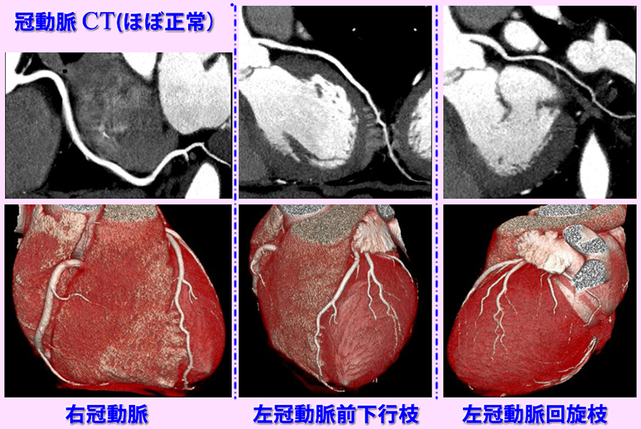 正常冠動脈